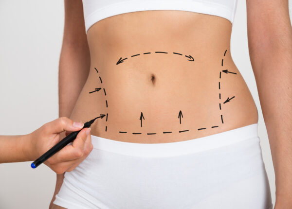 Liposucción + Mini Abdominoplastia + BBL